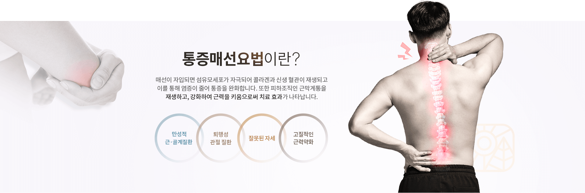 매선요법