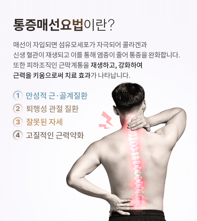 매선요법